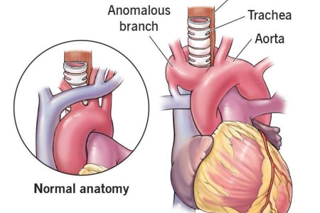 Vascular Rings