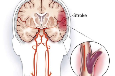 Ischemic Stroke
