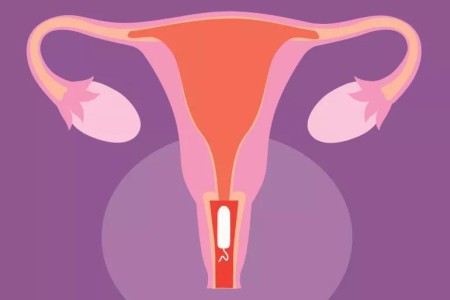 Can a Tampon Get Stuck? Here’s How To Remove It