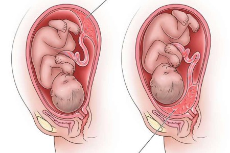 Placenta Previa