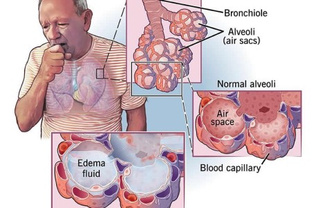 Pulmonary Edema