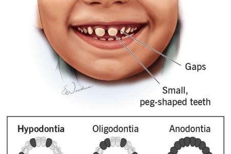 Hypodontia (Missing Teeth)