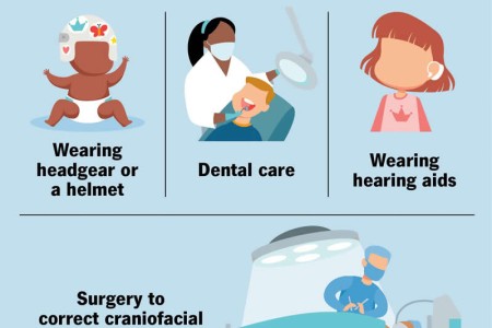 Cleidocranial Dysplasia