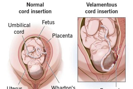 Velamentous Cord Insertion