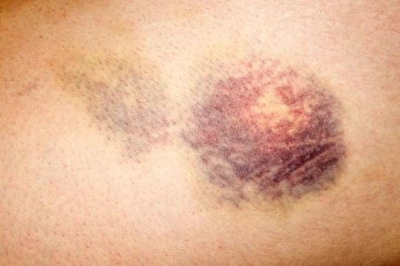 What To Do if Your Bruise Won’t Go Away