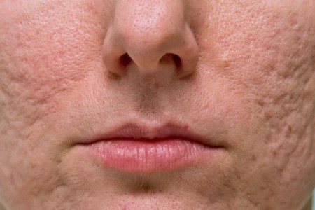 The Best Treatments To Get Rid of Acne Scars