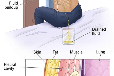 Thoracentesis