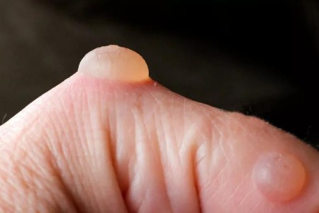 Should You Pop a Blister?