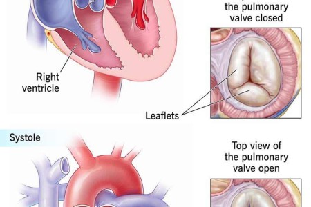 Pulmonary Valve