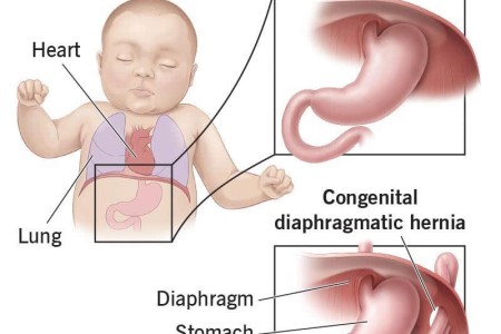 Congenital Diaphragmatic Hernia