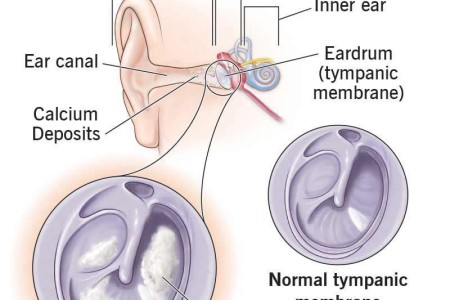 Tympanosclerosis
