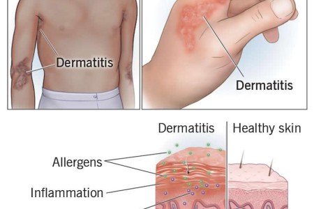 Atopic Dermatitis