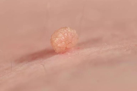 Skin Tag Removal: Why You Shouldn’t DIY