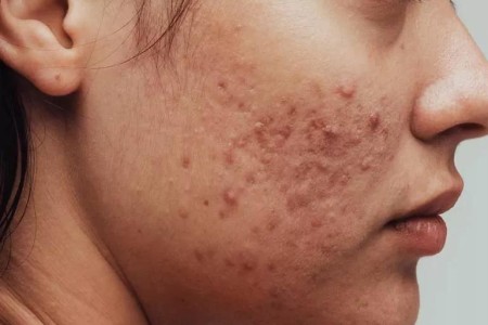 What It Means When Acne Is on Certain Areas of Your Face