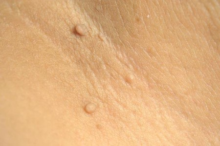Vaginal Skin Tags