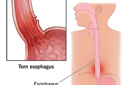 Esophageal Perforation (Esophageal Rupture)