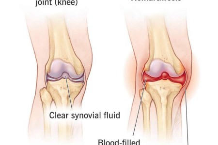 Hemarthrosis (Joint Bleeding)
