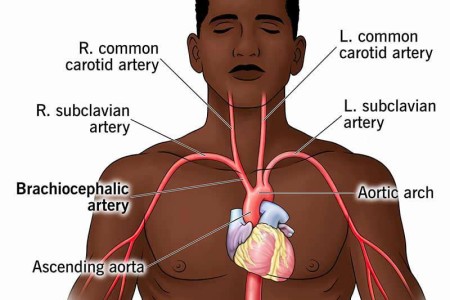 Brachiocephalic Artery