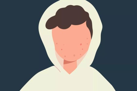 The Best Acne Treatments for Teens