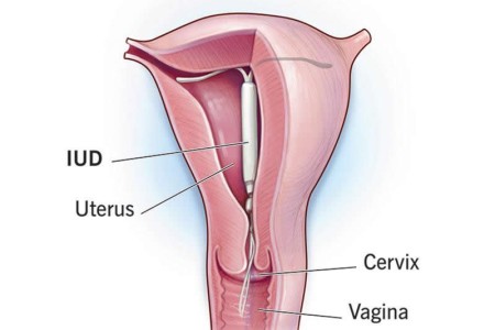 Intrauterine Device (IUD)
