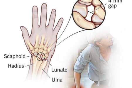 Sprained Wrist