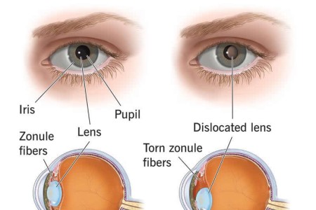 Ectopia Lentis