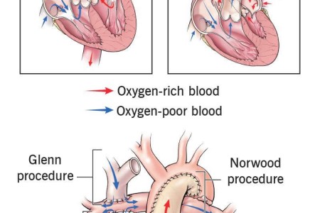 Fontan Procedure