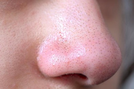 Sebaceous Filaments