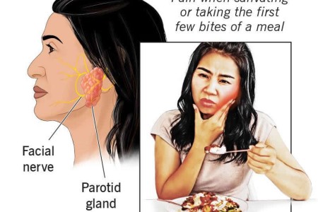 First Bite Syndrome