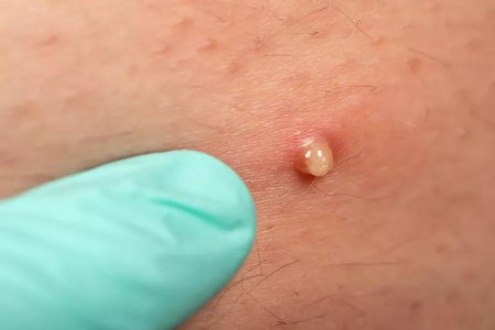 Butt Acne: Causes, Treatment and Prevention