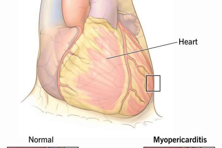 Myopericarditis