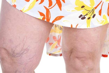 Spider Veins