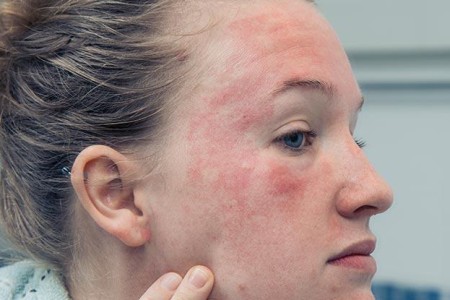 Eczema on Face