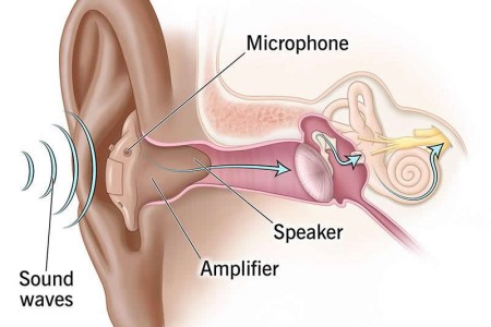 Hearing Aids