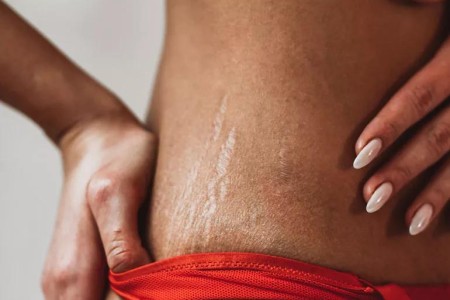Cocoa Butter Won’t Help Stretch Marks, but These Options Can