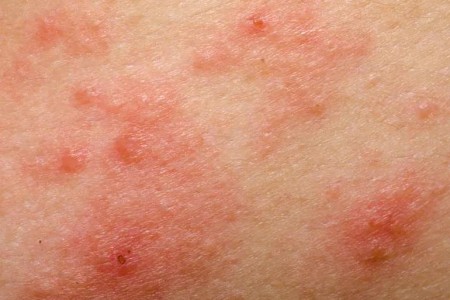 Some Medications Can Make Your Skin Sensitive to the Sun
