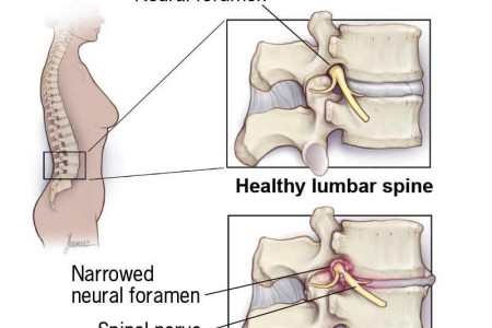 Foraminal Stenosis