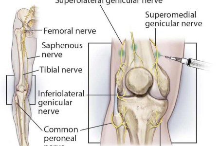 Genicular Nerve Block