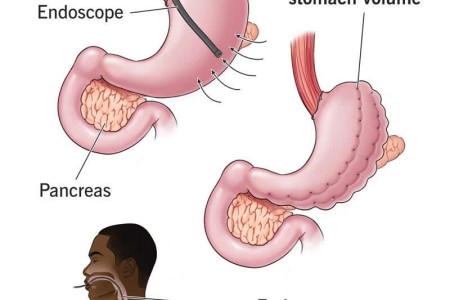 Endoscopic Sleeve Gastroplasty