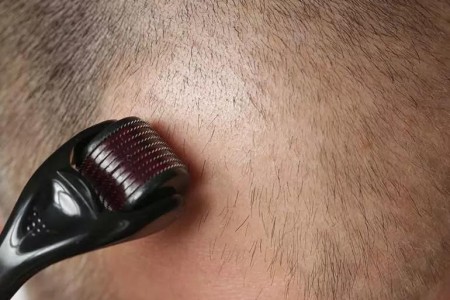 Can Microneedling Treat Hair Loss?