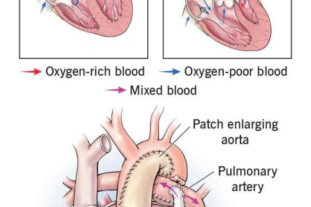 Norwood Procedure