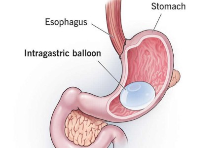 Intragastric Balloon