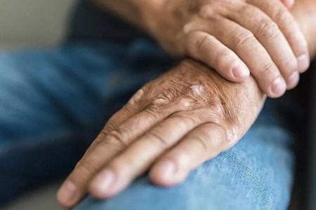 Ways To Prevent Psoriatic Arthritis Flare-Ups
