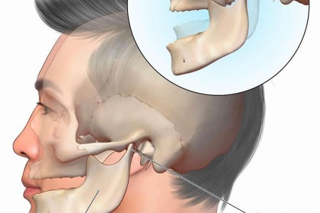 Dislocated Jaw