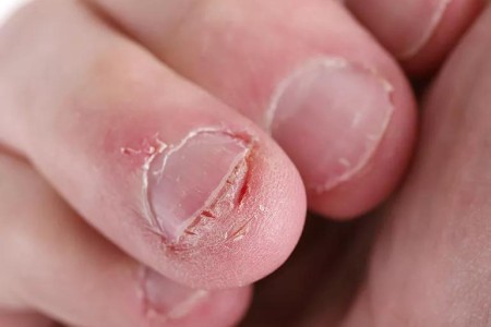 How To Stop Nail Biting