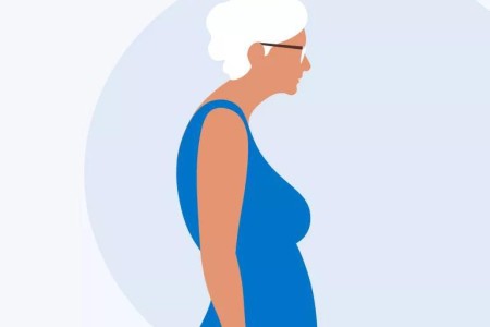 Dowager’s Hump: What It Is and How To Get Rid of It