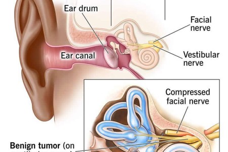 Acoustic Neuroma