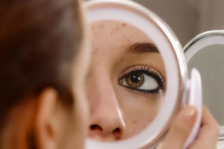 How To Get Rid of a Pimple — Stat!