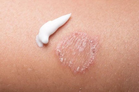 A Rash Decision: How To Cure Ringworm