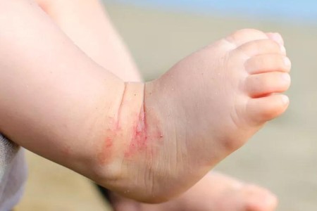 Treating and Managing Your Kid’s Eczema